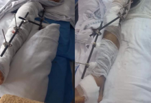 Photo of Vrea să se întoarcă acasă pe picioarele lui. Un moldovean, rănit grav într-un accident în România, are nevoie de ajutorul nostru