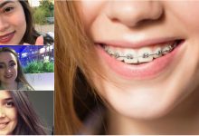 Photo of #PrimaDată. „Cucerește-ți” sănătatea cu un zâmbet frumos. Ce trebuie să știi când porți primul tău aparat dentar?