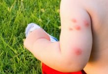 Photo of Țânțarii ți-au devenit principalii dușmani în această vară? 12 remedii naturale pentru înțepăturile lor