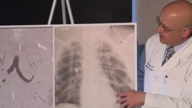 Photo of Un tânăr a ajuns la spital din cauza țigărilor electronice. Ce au descoperit medicii în plămânii acestuia?