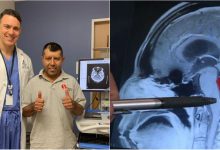 Photo of foto | După mai mulți ani de dureri chinuitoare de cap, un bărbat a descoperit că avea viermi la creier