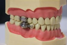 Photo of „Un instrument de tortură”: Un dispozitiv care împiedică deschiderea gurii, alternativa controversată la curele de slăbire