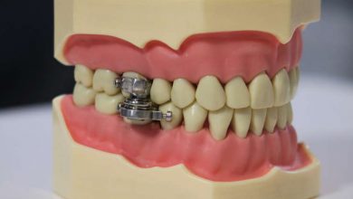 Photo of „Un instrument de tortură”: Un dispozitiv care împiedică deschiderea gurii, alternativa controversată la curele de slăbire