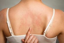 Photo of Ce este alergia solară și cum poate fi prevenită și tratată