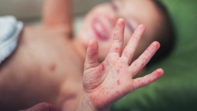 Photo of Epidemie de rujeolă în Afganistan: Zeci de mii de cazuri suspecte şi 150 de morţi