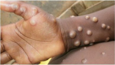 Photo of Al doilea caz de variola maimuței, confirmat în țara noastră.  Moldoveanul ar fi revenit recent de la Paris