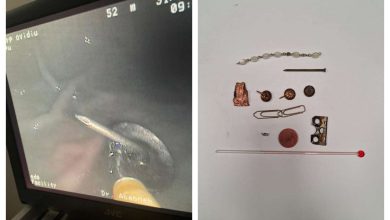 Photo of foto | Piuneze, cuie, agrafe, o brățară, o balama și un termometru cu mercur, scoase din stomacul unui bărbat. S-a întâmplat în România