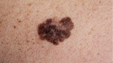 Photo of Cancerul de piele: ce simptome trebuie să ne alerteze