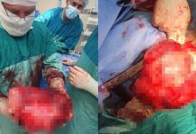 Photo of foto | O tumoare de aproape 5 kg, înlăturată cu succes de chirurgii IMSP „Timofei Moșneaga”: Plămânul pacientei practic nu funcționa