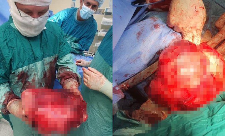Photo of foto | O tumoare de aproape 5 kg, înlăturată cu succes de chirurgii IMSP „Timofei Moșneaga”: Plămânul pacientei practic nu funcționa