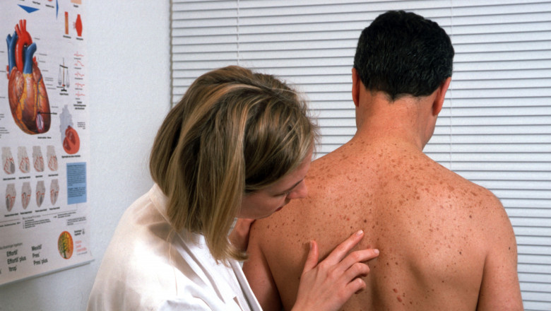 Photo of Două mari companii americane vor crea un vaccin împotriva cancerului de piele 