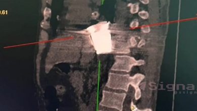 Photo of foto | „Bomba umană”. Un soldat rus avea o grenadă neexplodată sub inimă
