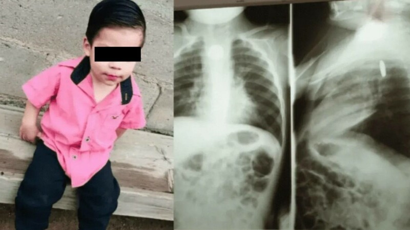 Photo of Un copil de doi ani a înghițit o baterie care a explodat in interiorul lui. Ce a urmat