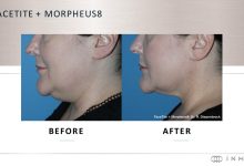 Photo of Morpheus 8 – viitorul rejuvenării faciale non-chirurgicale