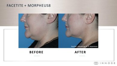 Photo of Morpheus 8 – viitorul rejuvenării faciale non-chirurgicale