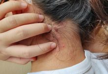 Photo of Încă un stat european a confirmat un caz de lepră. Autorităţile pregătesc reguli mai stricte pentru lucrătorii străini