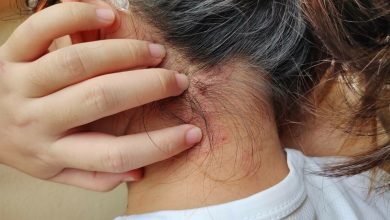 Photo of Încă un stat european a confirmat un caz de lepră. Autorităţile pregătesc reguli mai stricte pentru lucrătorii străini