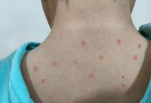 Photo of Caz de infectare cu variola maimuței, înregistrat în R. Moldova