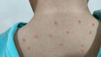 Photo of Caz de infectare cu variola maimuței, înregistrat în R. Moldova