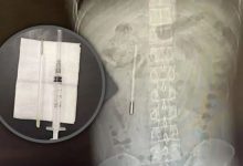 Photo of Un bărbat cu dureri abdominale a descoperit că avea în corp un termometru cu mercur înghițit cu 20 de ani în urmă