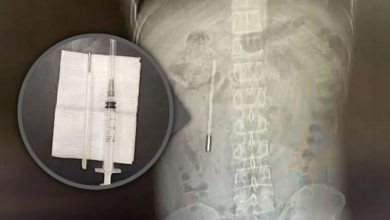 Photo of Un bărbat cu dureri abdominale a descoperit că avea în corp un termometru cu mercur înghițit cu 20 de ani în urmă
